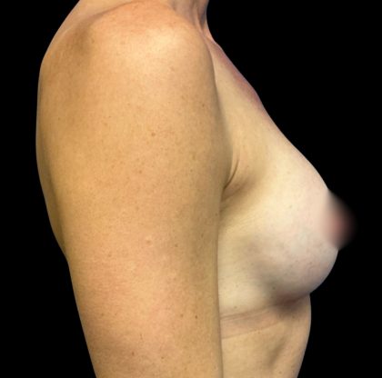 Breast Augmentation Before & After Patient #6572