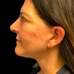 Facelift Before & After Patient #6573