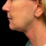 Facelift Before & After Patient #6574