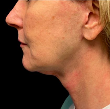 Facelift Before & After Patient #6574