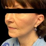 Facelift Before & After Patient #6575