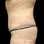 Liposuction Before & After Patient #6577