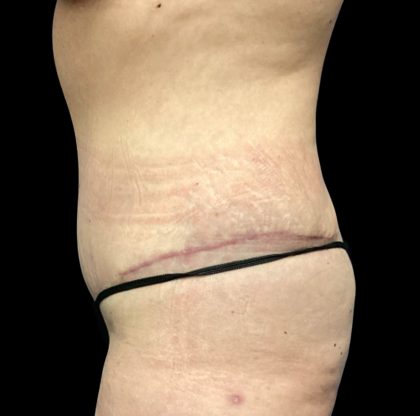 Liposuction Before & After Patient #6577