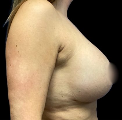 Implant Removal Before & After Patient #6578