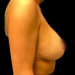 Mastopexy Augmentation Before & After Patient #6581