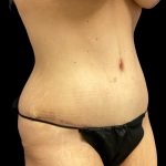 Mommy Makeover Before & After Patient #6582