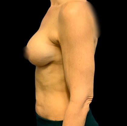 Breast Augmentation Before & After Patient #6550