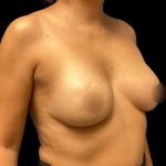 Breast Augmentation Before & After Patient #6551