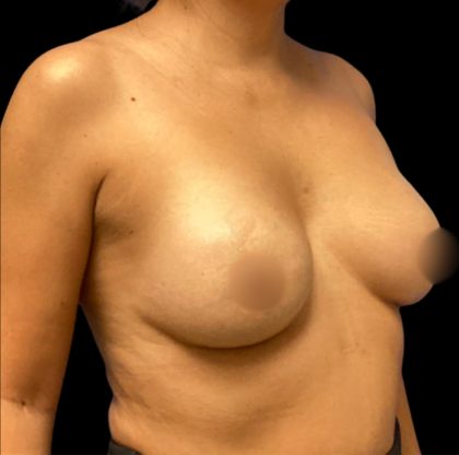 Breast Augmentation Before & After Patient #6551