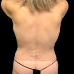 Circumferential Abdomen Before & After Patient #6553