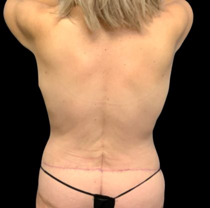 Circumferential Abdomen Before & After Patient #6553