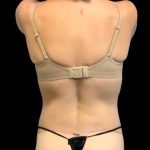 Circumferential Abdomen Before & After Patient #6554