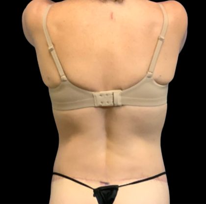 Circumferential Abdomen Before & After Patient #6554