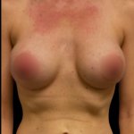 Breast Augmentation Before & After Patient #6540