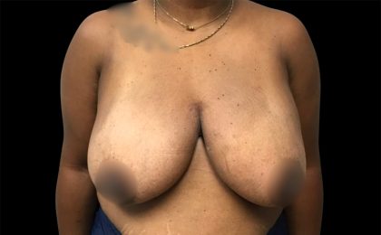 Breast Reduction Before & After Patient #6743