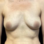 Breast Augmentation Before & After Patient #6744