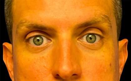 Blepharoplasty Before & After Patient #6742