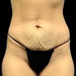 Mommy Makeover Before & After Patient #6740