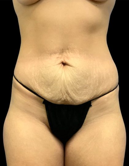 Mommy Makeover Before & After Patient #6740