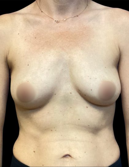 Breast Augmentation Before & After Patient #6744