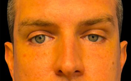 Blepharoplasty Before & After Patient #6742