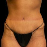 Mommy Makeover Before & After Patient #6740