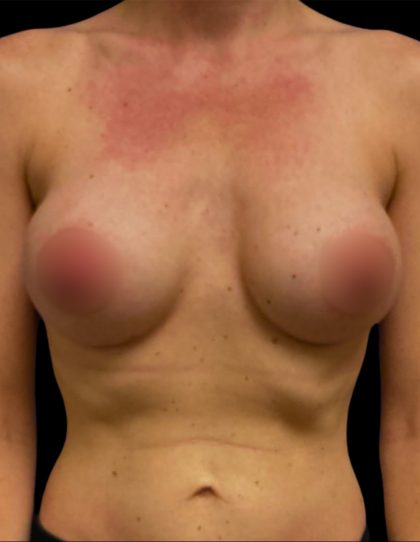 Breast Augmentation Before & After Patient #6744