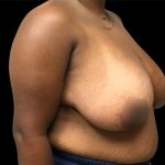 Breast Reduction Before & After Patient #6743