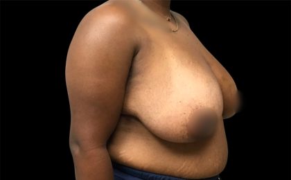 Breast Reduction Before & After Patient #6743