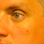 Blepharoplasty Before & After Patient #6742