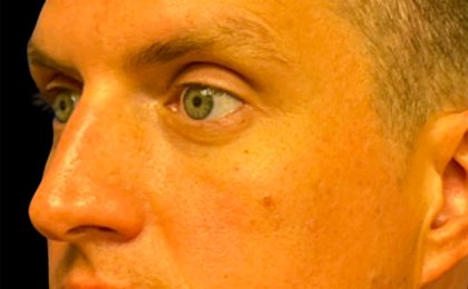Blepharoplasty Before & After Patient #6742