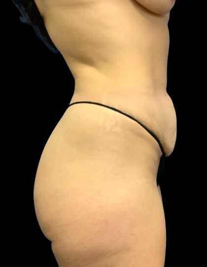 Mommy Makeover Before & After Patient #6740