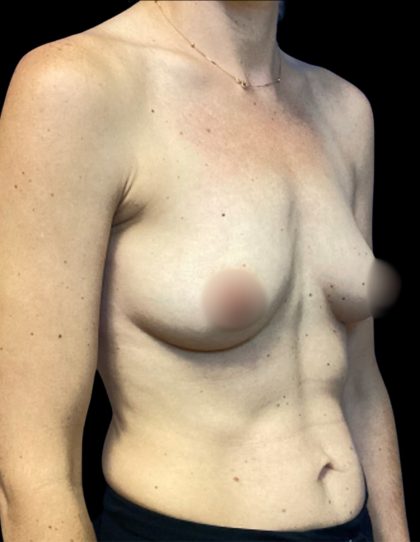 Breast Augmentation Before & After Patient #6744