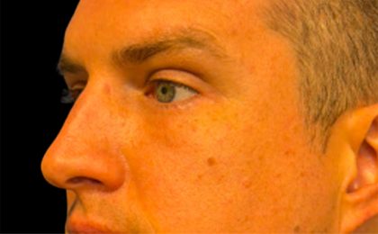 Blepharoplasty Before & After Patient #6742