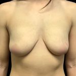 Mommy Makeover Before & After Patient #6740