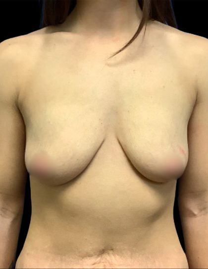 Mommy Makeover Before & After Patient #6740
