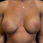 Mommy Makeover Before & After Patient #6740