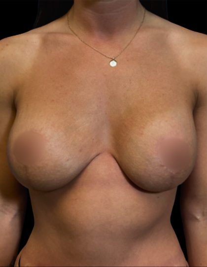 Mommy Makeover Before & After Patient #6740