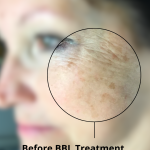 Skincare Treatment Before & After Patient #6860