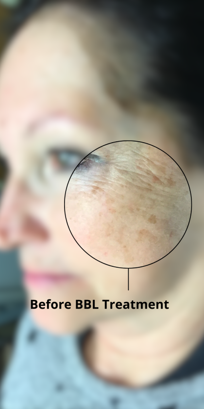 Skincare Treatment Before & After Patient #6860