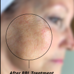 Skincare Treatment Before & After Patient #6860