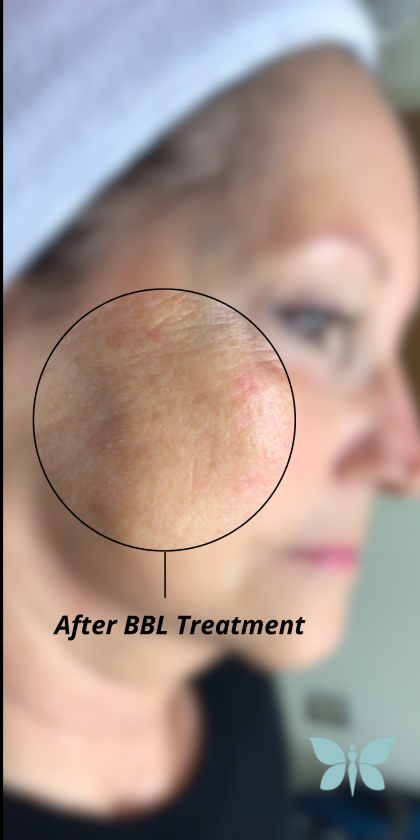 Skincare Treatment Before & After Patient #6860