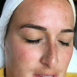 Skincare Treatment Before & After Patient #6861