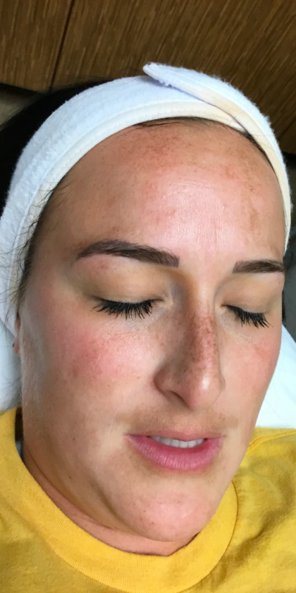 Skincare Treatment Before & After Patient #6861