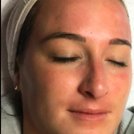 Skincare Treatment Before & After Patient #6861
