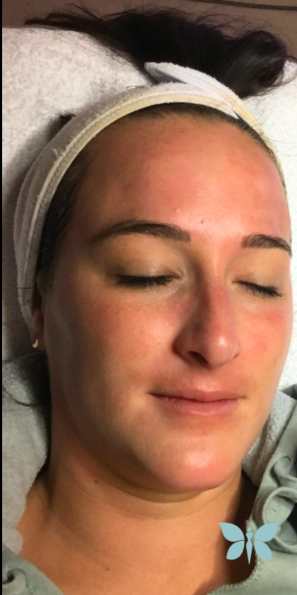 Skincare Treatment Before & After Patient #6861
