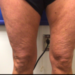 Skincare Treatment Before & After Patient #6862