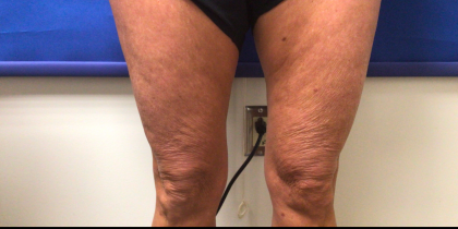 Skincare Treatment Before & After Patient #6862