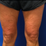 Skincare Treatment Before & After Patient #6862