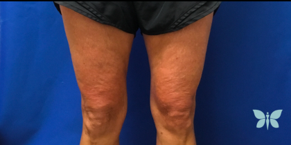 Skincare Treatment Before & After Patient #6862